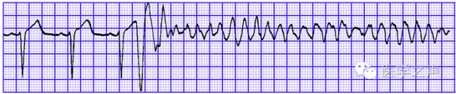 为什么选择双相波心律失常——室颤患者的处置及电复律使用_https://www.jmylbn.com_新闻资讯_第13张