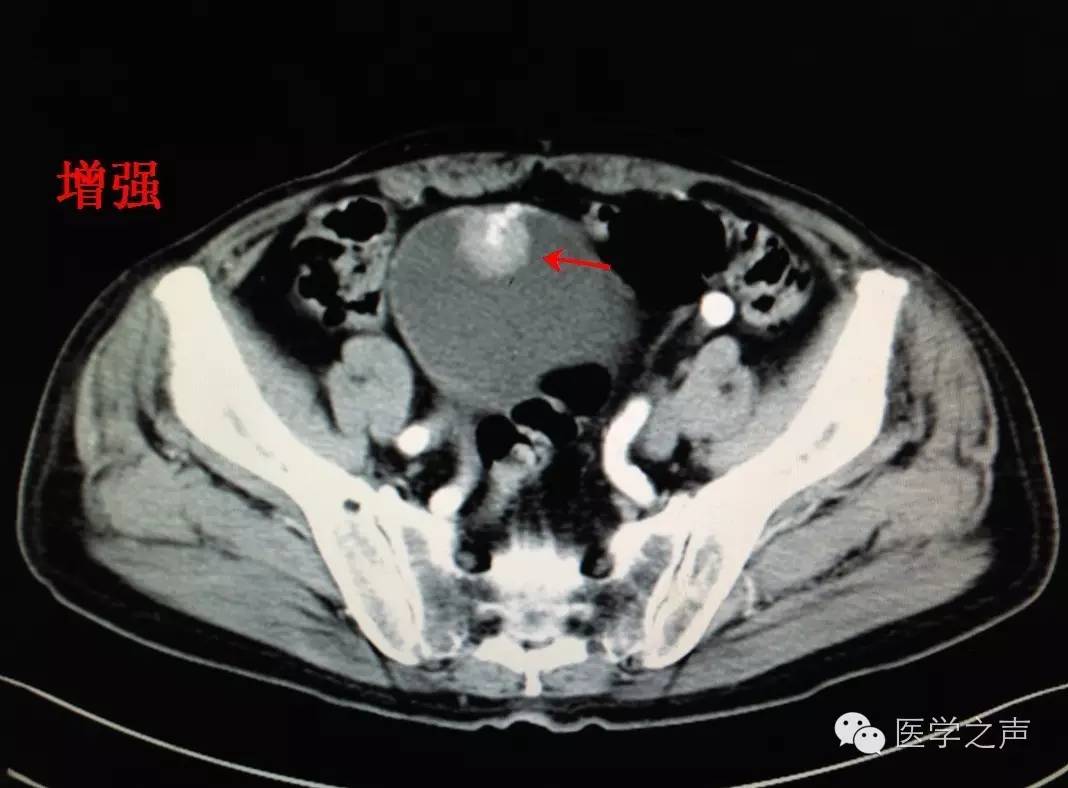 膀胱囊肿ct图片图片