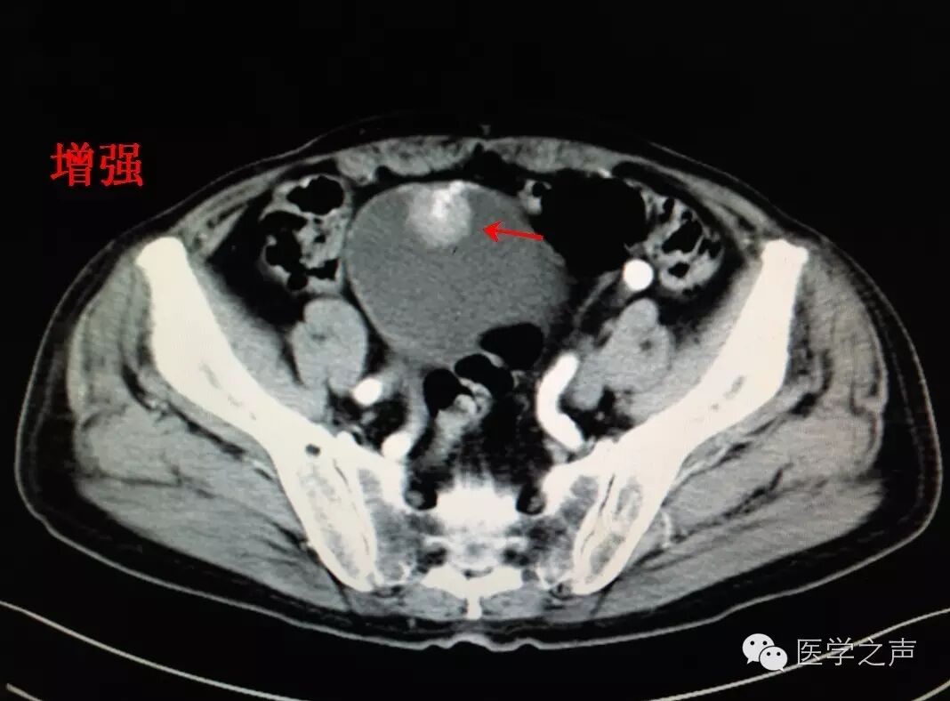 膀胱肿瘤主要特点:1.好发于年龄:40岁以上男性.