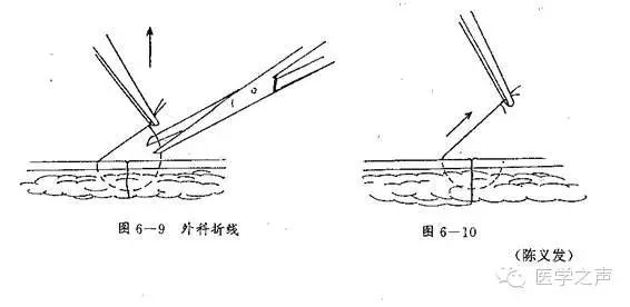拆线剪怎么拿各类手术刀口的最佳拆线时间以及注意事项_https://www.jmylbn.com_新闻资讯_第1张