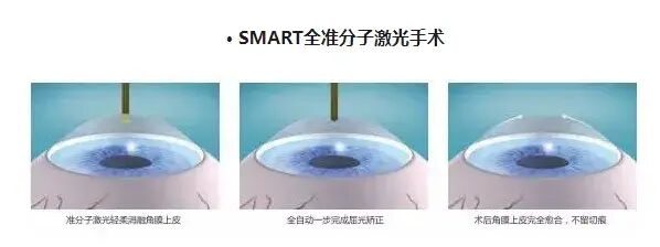 smart怎么治SMART全激光治疗近视！你需要了解这些_https://www.jmylbn.com_新闻资讯_第4张