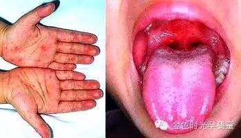手足口病高峰期将到,6招教宝宝远离病毒.爸妈必看!