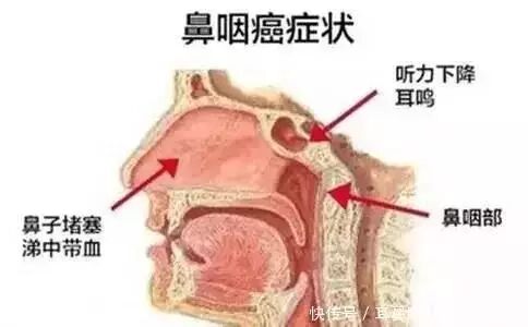 有一种鼻出血、鼻炎，能致癌!你绝对小看不得......