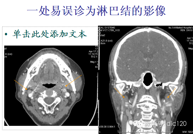 上界為環狀軟骨下緣,前,後界與Ⅲ區相同,分別為胸鎖乳突肌前內緣和後