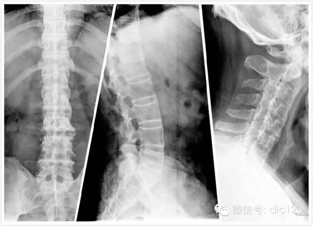 强直性脊柱炎典型影像表现及其病理生理_医学界-助力医生临床决策和