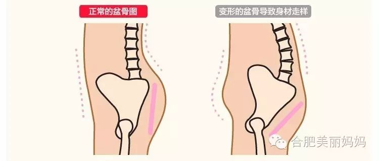 【美麗媽媽】產後身材走樣 從骨盆恢復開始