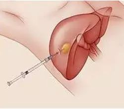 會「行走」的腫瘤 健康 第3張