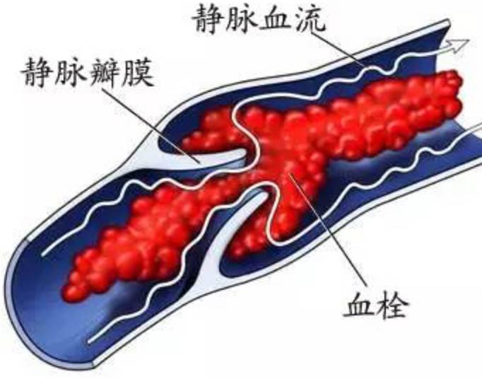出现以下症状时，警惕深静脉血栓