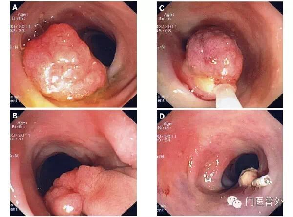 早期防治结肠息肉避免大肠癌的发生