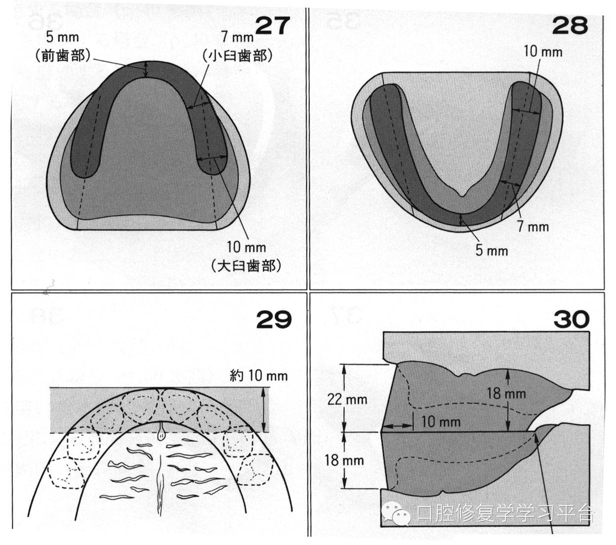 全口义齿的制作合堤