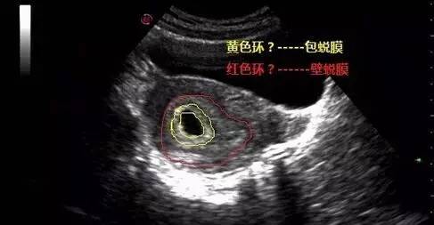 早孕双环征男女图片