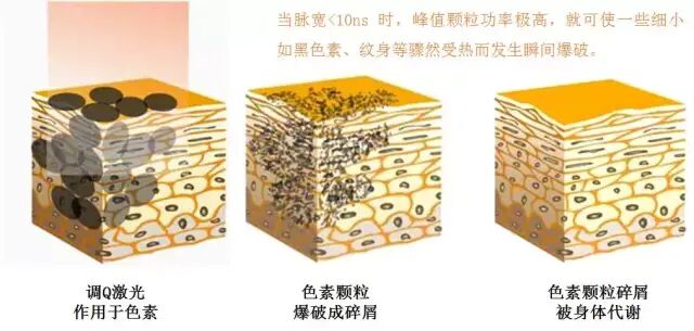 什么是牵引床什么是老年疣，如何治疗？_https://www.jmylbn.com_新闻资讯_第5张