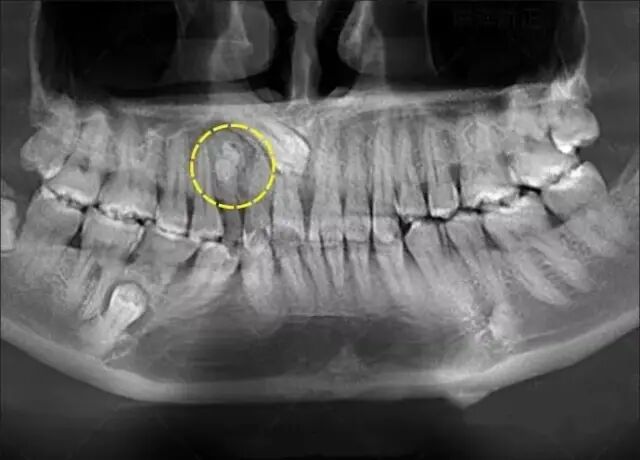 曲面断层片怎么看科普知识：你会看牙片嘛？今天手把手教你看！_https://www.jmylbn.com_新闻资讯_第12张