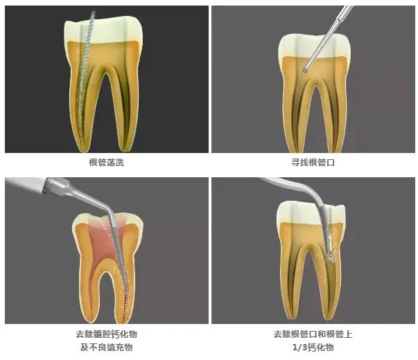 牙周治疗仪怎么做牙周【口腔健康】江西医专第一附属医院口腔科引进超声牙周治疗仪，助力牙齿健康_https://www.jmylbn.com_新闻资讯_第5张
