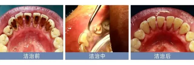 牙周治疗仪怎么做牙周【口腔健康】江西医专第一附属医院口腔科引进超声牙周治疗仪，助力牙齿健康_https://www.jmylbn.com_新闻资讯_第4张