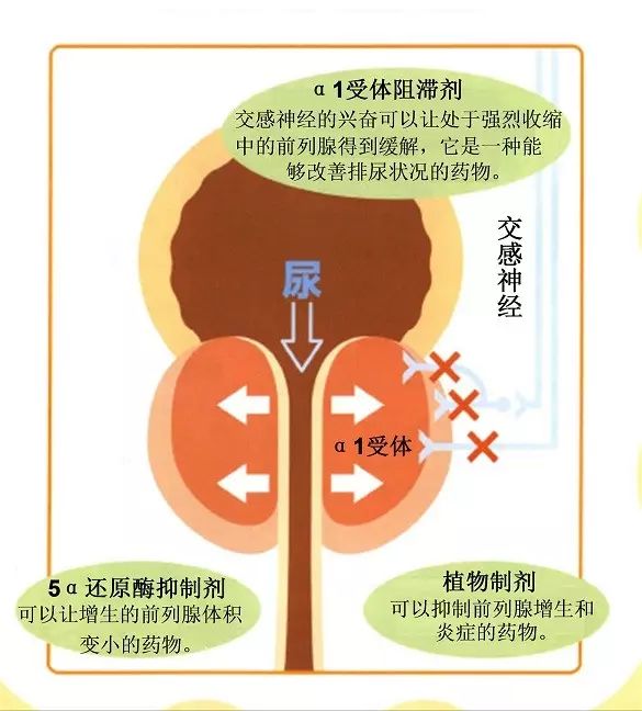 郑大一附院 闫亮 文章列表>良性前列腺增生的治疗 如果排尿症状较重