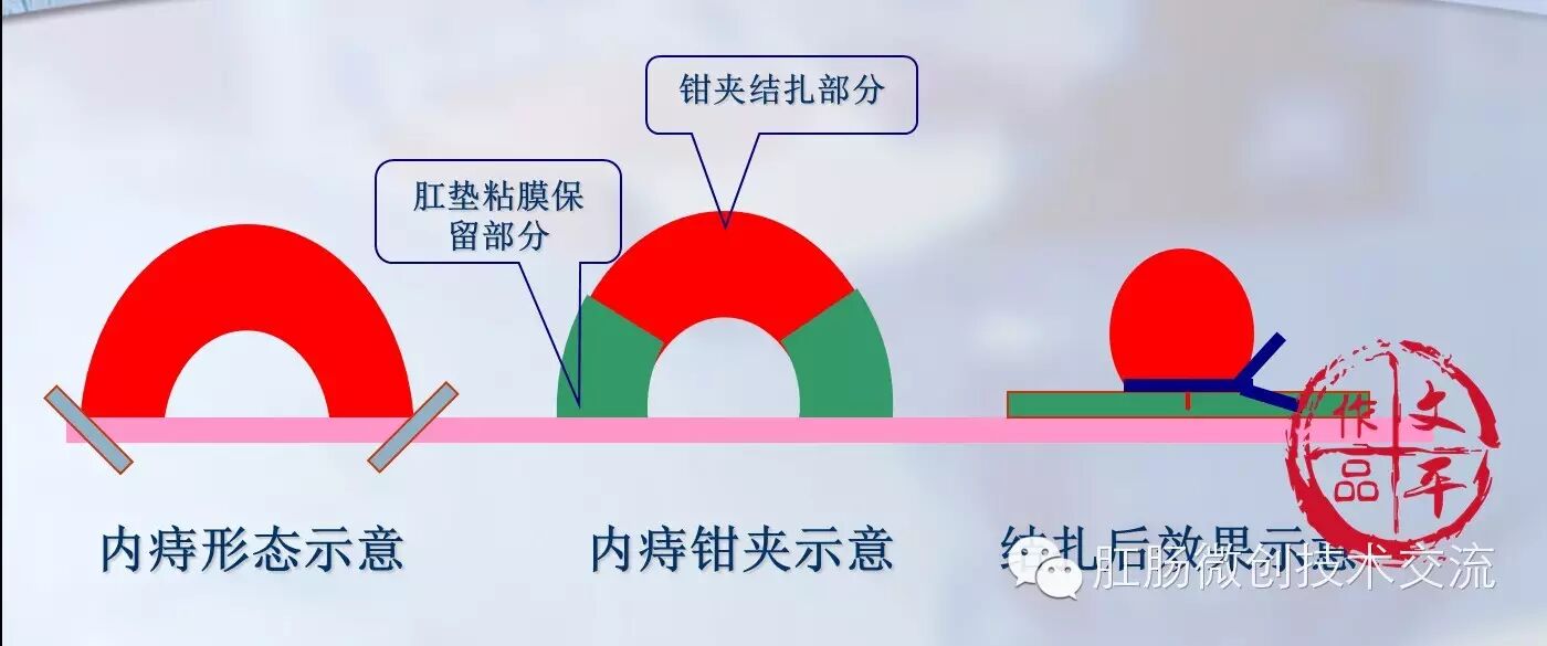 痔解剖学(外剥内扎)手术(陈文平) - 好大夫在线
