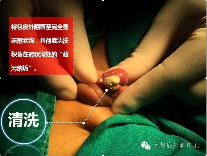 绝大多数包皮过长或者包茎最早和最常见的表现就是冠状沟"藏污纳垢"