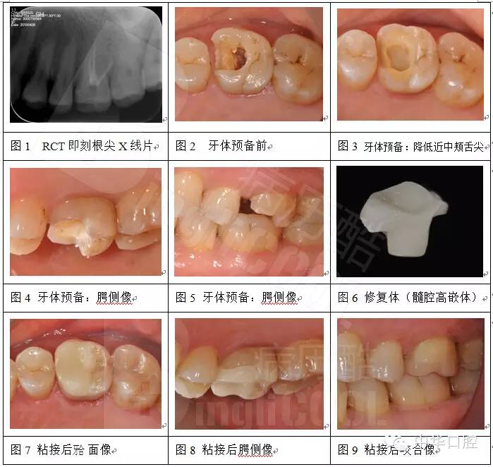 椅旁cadcam全瓷高嵌体修复根管治疗后磨牙缺损