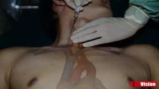 中心静脉导管怎么用中心静脉置管术的4个常见小技巧_https://www.jmylbn.com_新闻资讯_第8张