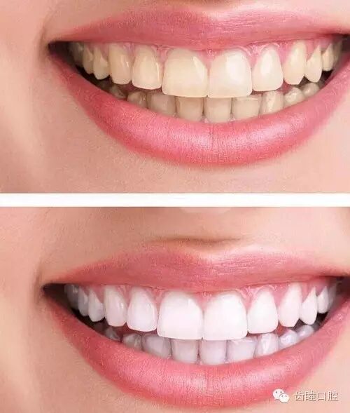 牙齿发黄变色很简单