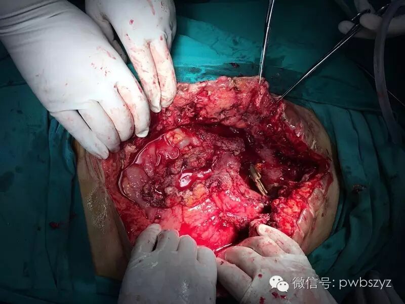 肠瘘肠梗阻典型病例系列之004----胃癌术后吻合口瘘 - 好大夫在线