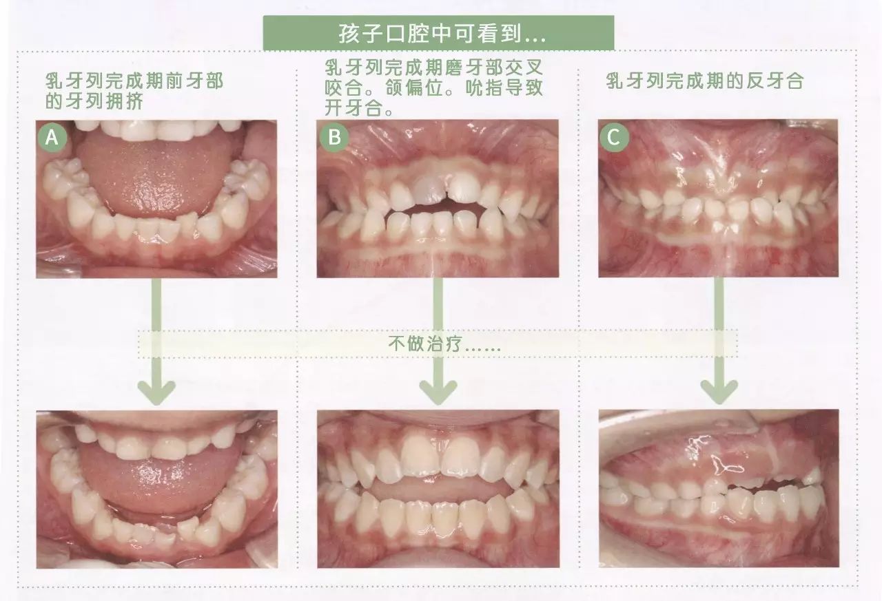 ▼ 乳牙列完成期發生咬合錯亂,恆牙也會出現咬合錯亂.