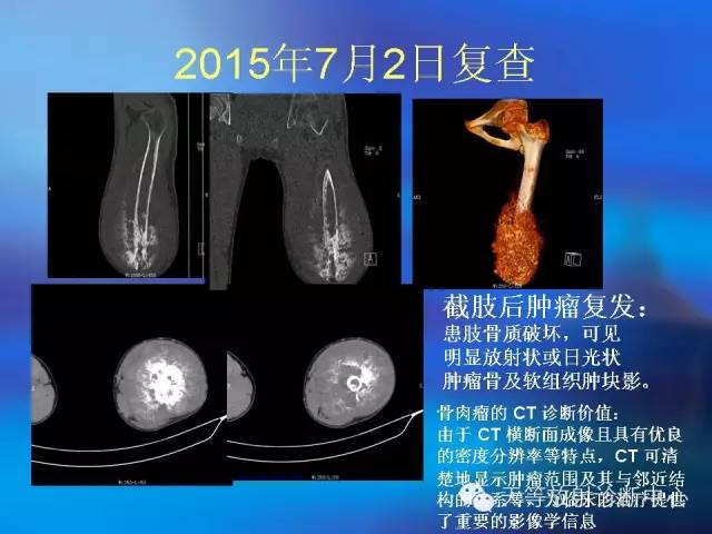 肌骨学组：骨肉瘤影像学表现