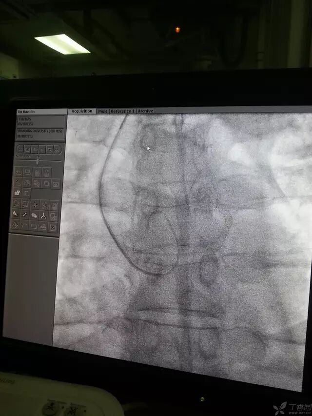 造影导丝是什么原来心脏造影这样做：冠脉造影全程图解_https://www.jmylbn.com_新闻资讯_第12张