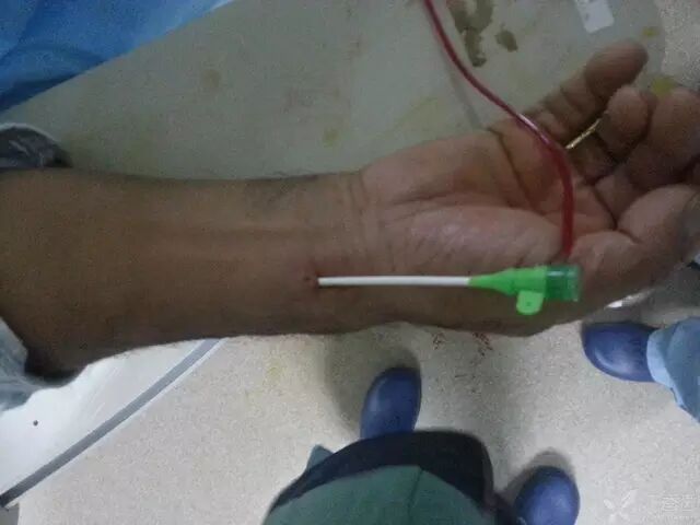 造影导丝是什么原来心脏造影这样做：冠脉造影全程图解_https://www.jmylbn.com_新闻资讯_第17张