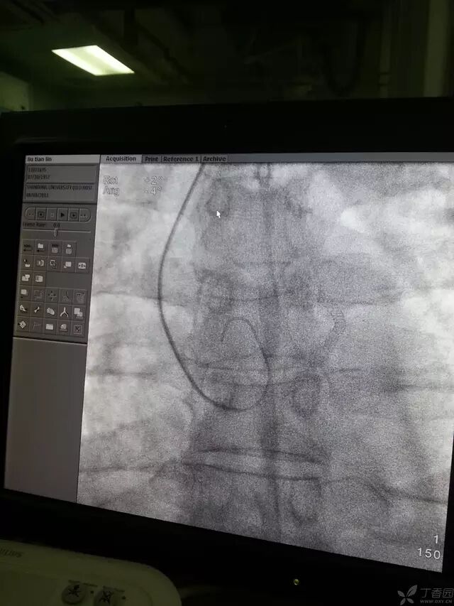 造影导丝是什么原来心脏造影这样做：冠脉造影全程图解_https://www.jmylbn.com_新闻资讯_第13张