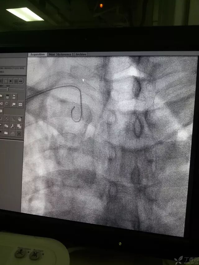 造影导丝是什么原来心脏造影这样做：冠脉造影全程图解_https://www.jmylbn.com_新闻资讯_第11张