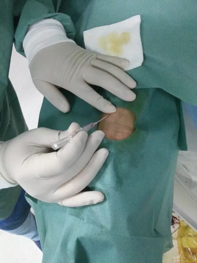 造影导丝是什么原来心脏造影这样做：冠脉造影全程图解_https://www.jmylbn.com_新闻资讯_第7张