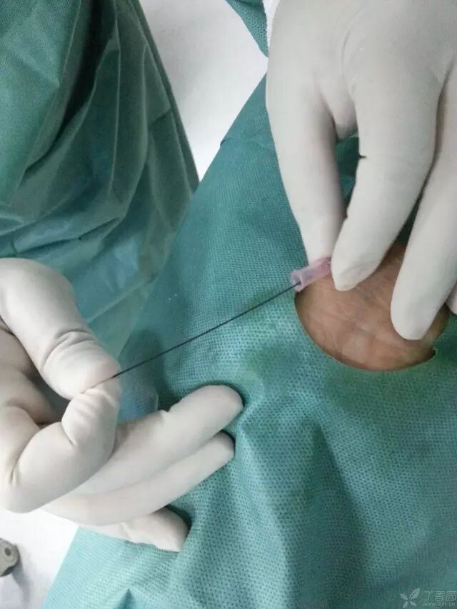 造影导丝是什么原来心脏造影这样做：冠脉造影全程图解_https://www.jmylbn.com_新闻资讯_第8张