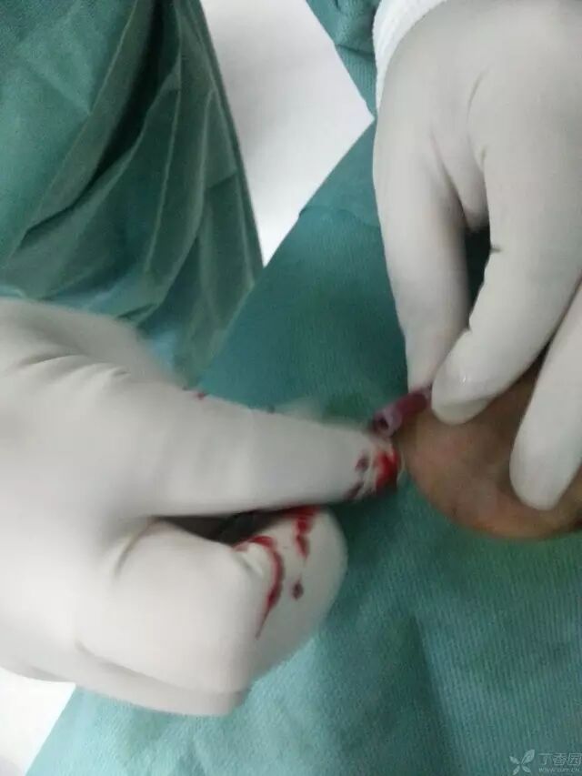 造影导丝是什么原来心脏造影这样做：冠脉造影全程图解_https://www.jmylbn.com_新闻资讯_第9张