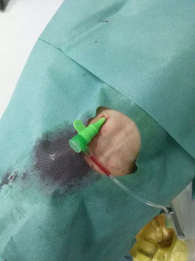 造影导丝是什么原来心脏造影这样做：冠脉造影全程图解_https://www.jmylbn.com_新闻资讯_第10张