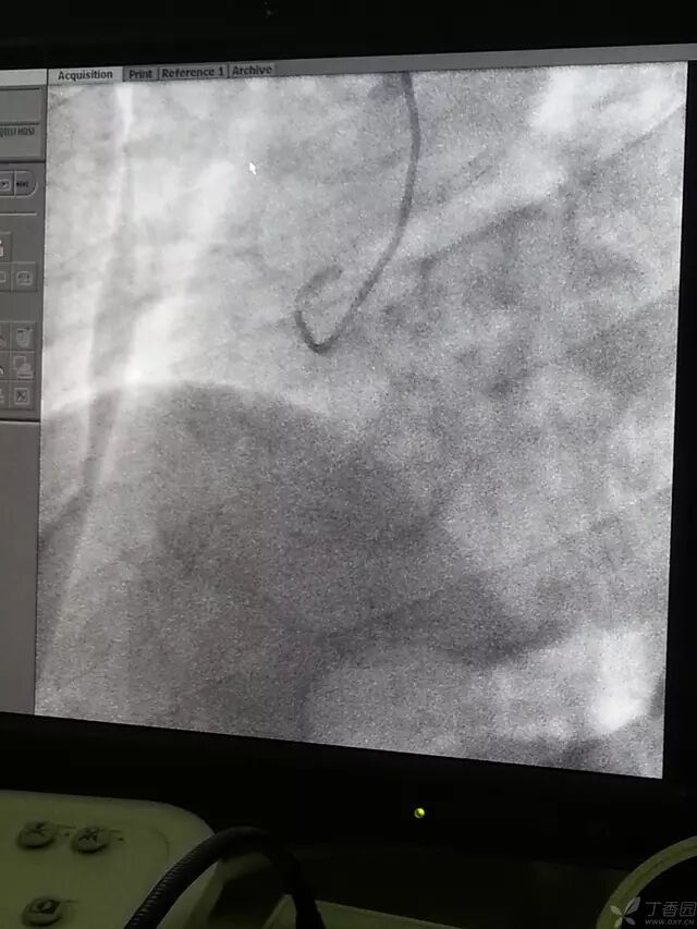 造影导丝是什么原来心脏造影这样做：冠脉造影全程图解_https://www.jmylbn.com_新闻资讯_第16张