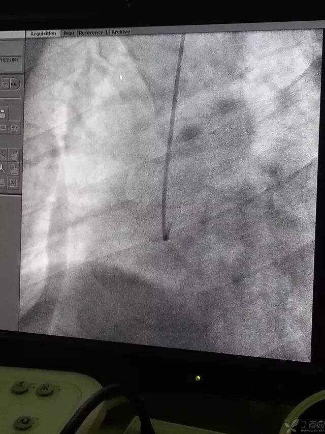 造影导丝是什么原来心脏造影这样做：冠脉造影全程图解_https://www.jmylbn.com_新闻资讯_第15张