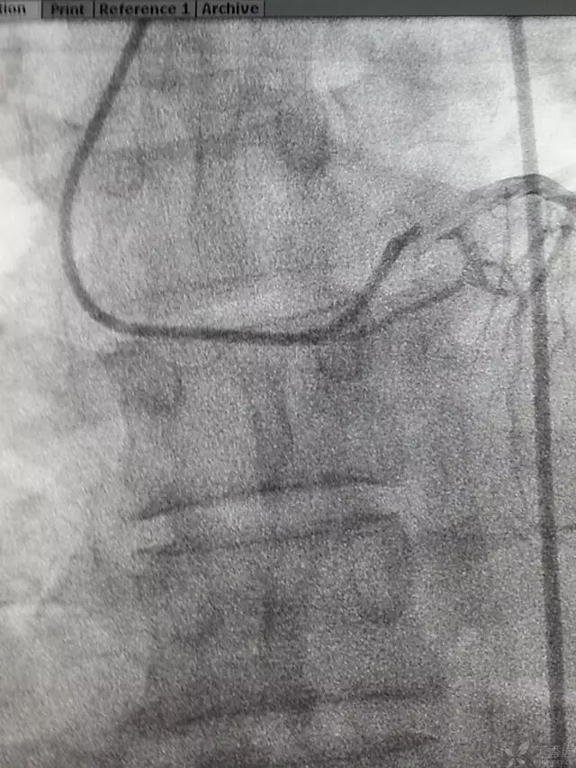 造影导丝是什么原来心脏造影这样做：冠脉造影全程图解_https://www.jmylbn.com_新闻资讯_第14张