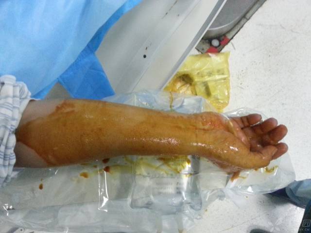 造影导丝是什么原来心脏造影这样做：冠脉造影全程图解_https://www.jmylbn.com_新闻资讯_第1张