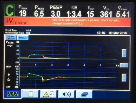 報警限設置過低參數設置:潮氣量,吸氣壓力,壓力支持設置過大3)呼吸機