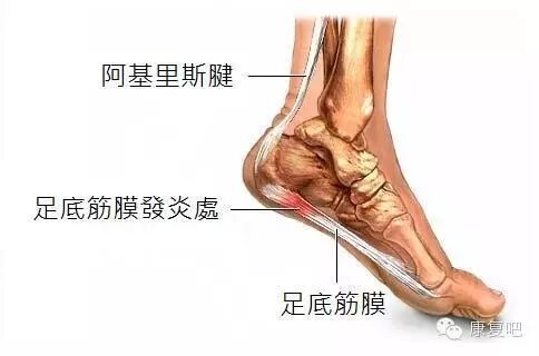 脚底的腱鞘炎怎么治愈 脚底的腱鞘炎怎么治愈 Kiodf网