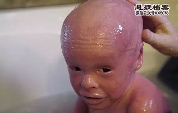 魚鱗男孩每天脱皮 須洗兩次澡才能保住其生命 懸疑檔案 微文庫