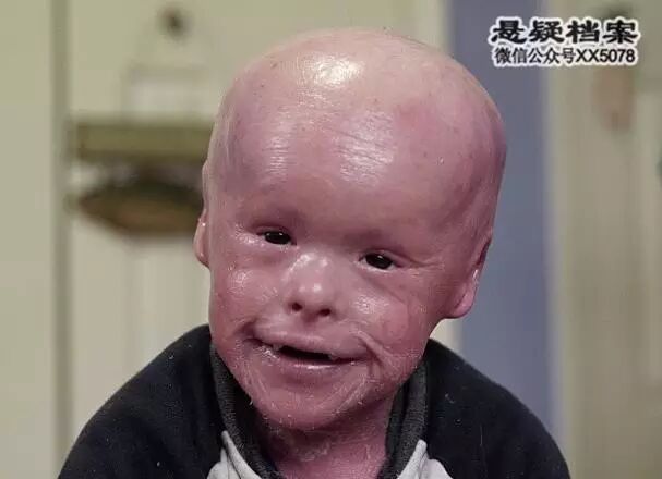 魚鱗男孩每天脱皮 須洗兩次澡才能保住其生命 懸疑檔案 微文庫