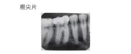 曲面断层片怎么看科普知识：你会看牙片嘛？今天手把手教你看！_https://www.jmylbn.com_新闻资讯_第3张