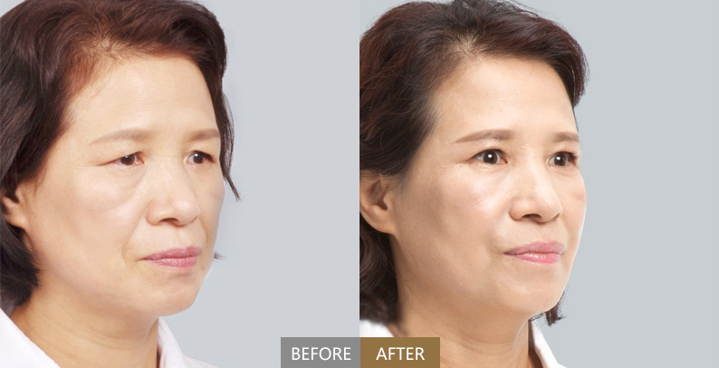 最专业超声刀介绍和案例分析