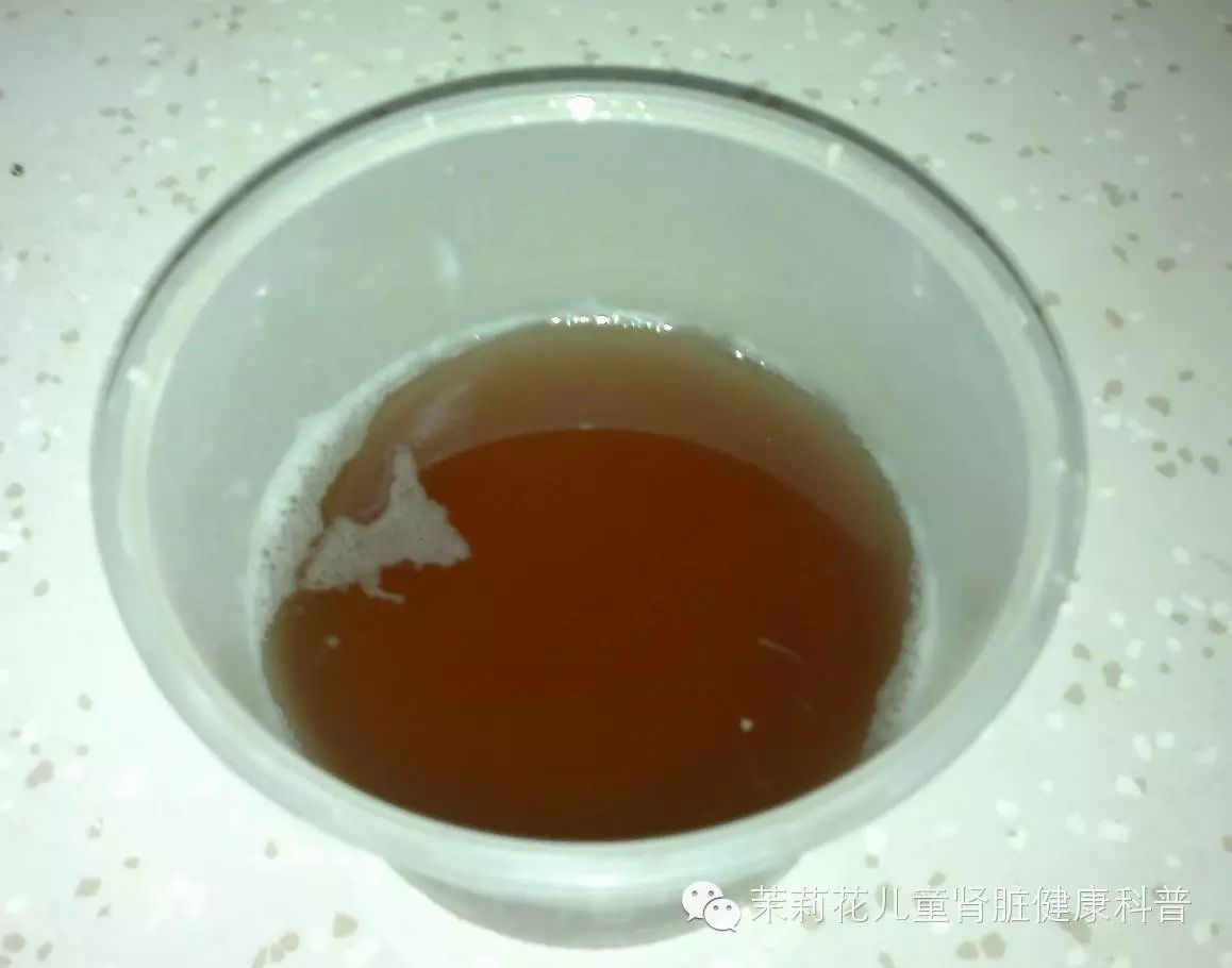 关于血尿的一些知识