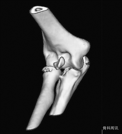 尺骨冠突骨折图片