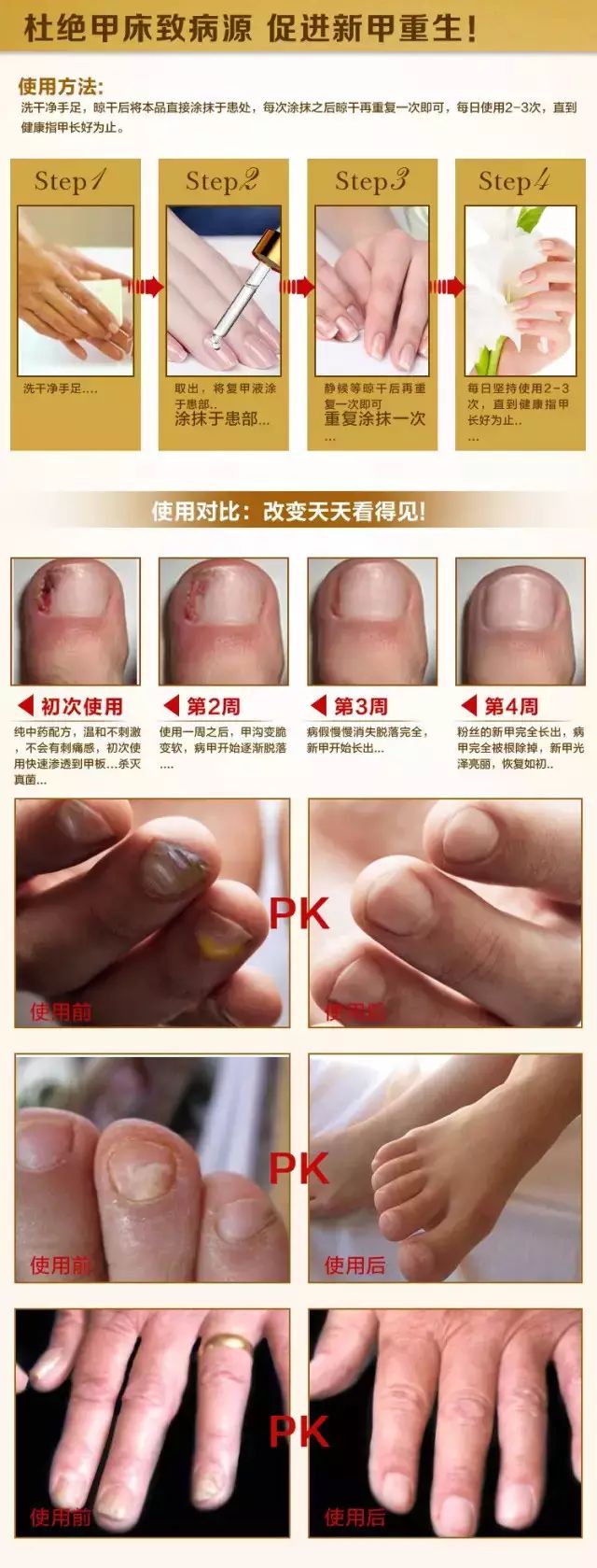 得了灰指甲,一个传染俩.你的指甲还好嘛?速度阻止一个传染俩的悲剧!