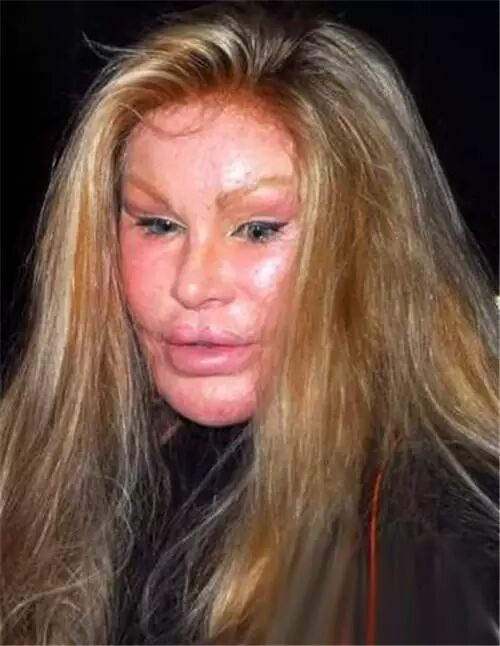 慎点!整容失败惊悚案例 美女一个个都整成怪物